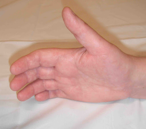 Pain Syndromes