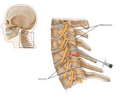 Cervical facet joint injections
