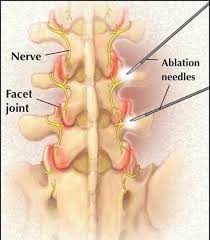 Facet/Sacro-iliac joint denervation